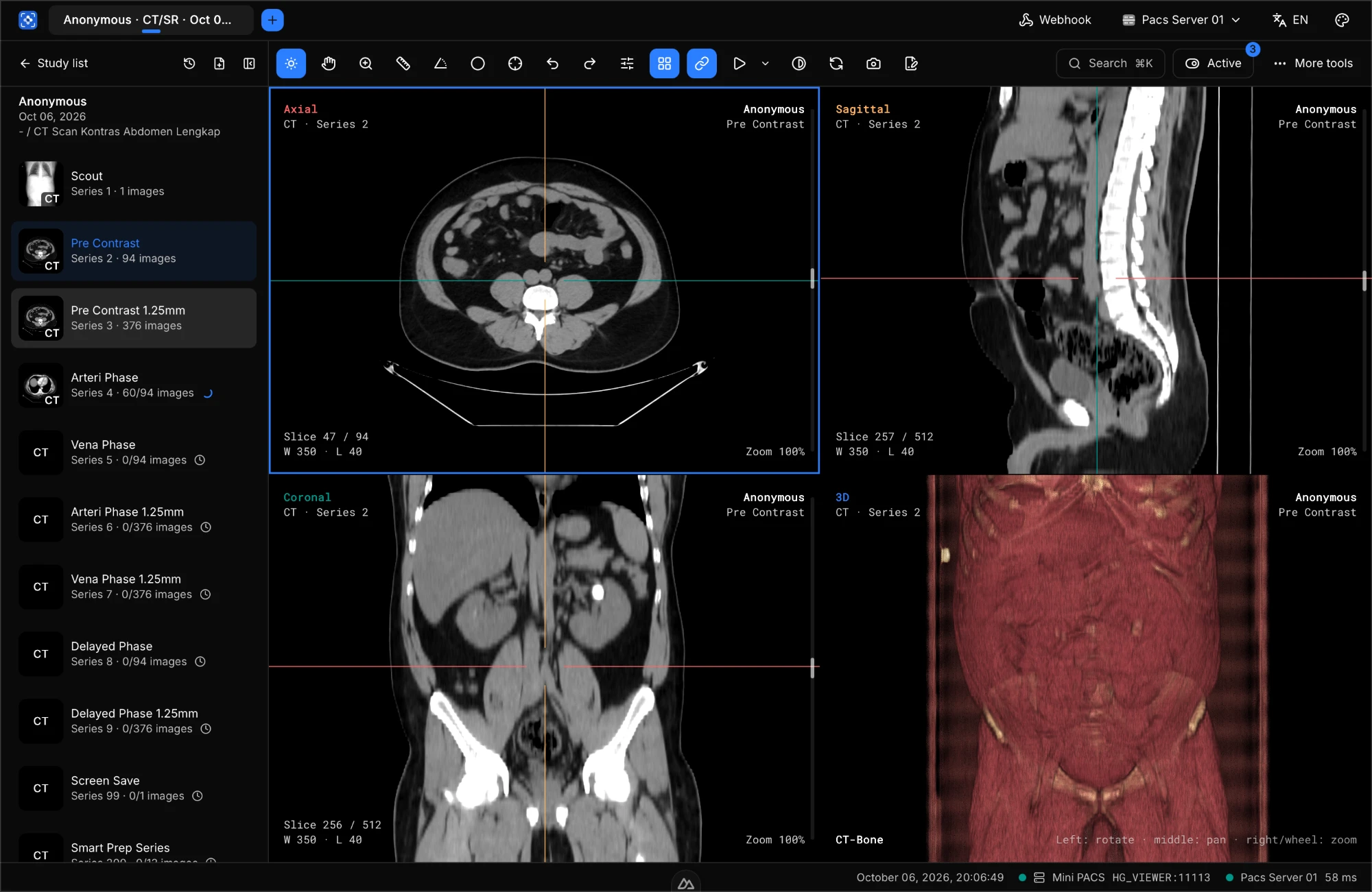 HISGrace PACS Viewer showing axial, sagittal, coronal, and 3D layouts